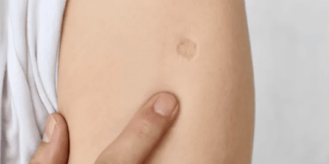Vacuna BCG: la inyección que deja cicatriz en el brazo y por qué no se aplica en Estados Unidos