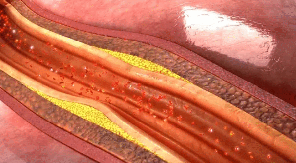 Hipertensión: no solo la sal influye, también el daño vascular y el flujo sanguíneo